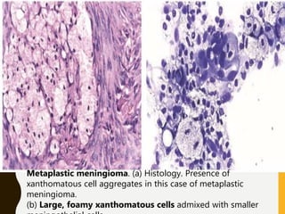 Metaplastic meningioma. (a) Histology. Presence of
xanthomatous cell aggregates in this case of metaplastic
meningioma.
(b) Large, foamy xanthomatous cells admixed with smaller
 