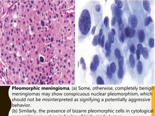 Pleomorphic meningioma. (a) Some, otherwise, completely benign
meningiomas may show conspicuous nuclear pleomorphism, which
should not be misinterpreted as signifying a potentially aggressive
behavior.
(b) Similarly, the presence of bizarre pleomorphic cells in cytological
 