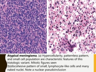 Atypical meningioma. (a) Hypercellularity, patternless pattern,
and small cell population are characteristic features of this
histologic variant. Mitotic figures seen
(b)discohesive pattern of small, lymphocyte-like cells and many
naked nuclei. Note a nuclear pseudoinclusion
 
