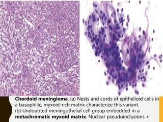 Chordoid meningioma. (a) Nests and cords of epithelioid cells in
a basophilic, myxoid-rich matrix characterize this variant.
(b) Undoubted meningothelial cell group embedded in a
metachromatic myxoid matrix. Nuclear pseudoinclusions +
 