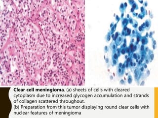Clear cell meningioma. (a) sheets of cells with cleared
cytoplasm due to increased glycogen accumulation and strands
of collagen scattered throughout.
(b) Preparation from this tumor displaying round clear cells with
nuclear features of meningioma
 