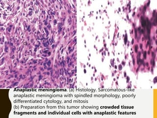 Anaplastic meningioma. (a) Histology. Sarcomatous-like
anaplastic meningioma with spindled morphology, poorly
differentiated cytology, and mitosis
(b) Preparation from this tumor showing crowded tissue
fragments and individual cells with anaplastic features
 