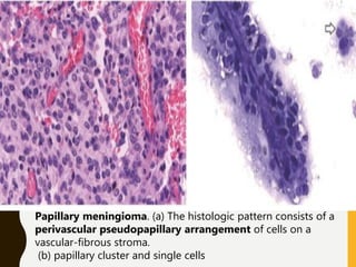 Papillary meningioma. (a) The histologic pattern consists of a
perivascular pseudopapillary arrangement of cells on a
vascular-fibrous stroma.
(b) papillary cluster and single cells
 