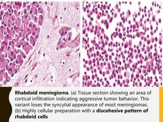 Rhabdoid meningioma. (a) Tissue section showing an area of
cortical infiltration indicating aggressive tumor behavior. This
variant loses the syncytial appearance of most meningiomas.
(b) Highly cellular preparation with a discohesive pattern of
rhabdoid cells
 