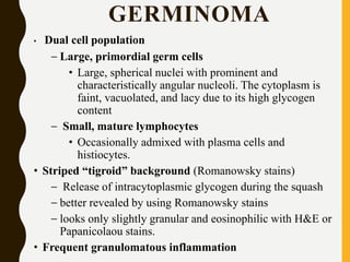 GERMINOMA
• Dual cell population
– Large, primordial germ cells
• Large, spherical nuclei with prominent and
characteristically angular nucleoli. The cytoplasm is
faint, vacuolated, and lacy due to its high glycogen
content
– Small, mature lymphocytes
• Occasionally admixed with plasma cells and
histiocytes.
• Striped “tigroid” background (Romanowsky stains)
– Release of intracytoplasmic glycogen during the squash
– better revealed by using Romanowsky stains
– looks only slightly granular and eosinophilic with H&E or
Papanicolaou stains.
• Frequent granulomatous inflammation
 