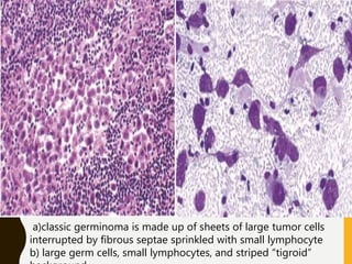 a)classic germinoma is made up of sheets of large tumor cells
interrupted by fibrous septae sprinkled with small lymphocyte
b) large germ cells, small lymphocytes, and striped “tigroid”
 