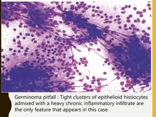 Germinoma pitfall : Tight clusters of epithelioid histiocytes
admixed with a heavy chronic inflammatory infiltrate are
the only feature that appears in this case
 