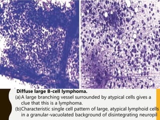 Diffuse large B-cell lymphoma.
(a)A large branching vessel surrounded by atypical cells gives a
clue that this is a lymphoma.
(b)Characteristic single cell pattern of large, atypical lymphoid cells
in a granular-vacuolated background of disintegrating neuropil
 