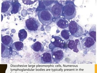 Discohesive large pleomorphic cells, Numerous
lymphoglandular bodies are typically present in the
 