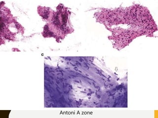 Antoni A zone
 