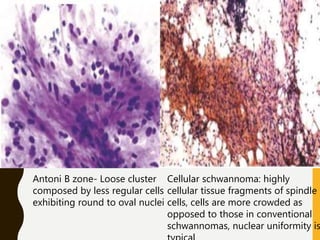 Antoni B zone- Loose cluster
composed by less regular cells
exhibiting round to oval nuclei
Cellular schwannoma: highly
cellular tissue fragments of spindle
cells, cells are more crowded as
opposed to those in conventional
schwannomas, nuclear uniformity is
 
