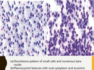 (a)Discohesive pattern of small cells and numerous bare
nuclei.
(b)Plasmacytoid features with oval cytoplasm and eccentric
 