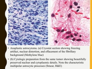 • Anaplastic astrocytoma. (a) Cryostat section showing freezing
artifact, nuclear distortion, and effacement of the fibrillary
background (Methylene blue)
• (b) Cytologic preparation from the same tumor showing beautifully
preserved nuclear and cytoplasmic details. Note the characteristic
multipolar astrocytic processes (Smear, H&E)
 