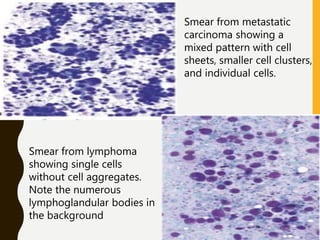 Smear from metastatic
carcinoma showing a
mixed pattern with cell
sheets, smaller cell clusters,
and individual cells.
Smear from lymphoma
showing single cells
without cell aggregates.
Note the numerous
lymphoglandular bodies in
the background
 