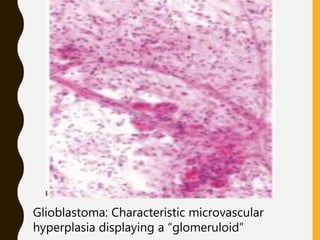 Glioblastoma: Characteristic microvascular
hyperplasia displaying a “glomeruloid”
 