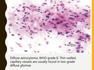 Diffuse astrocytoma, WHO grade II. Thin-walled,
capillary vessels are usually found in low-grade
diffuse gliomas
 