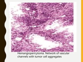 Hemangiopericytoma. Network of vascular
channels with tumor cell aggregates
 