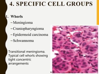 4. SPECIFIC CELL GROUPS
1. Whorls
–Meningioma
–Craniopharyngioma
–Epidermoid carcinoma
–Schwannoma
Transitional meningioma.
Typical cell whorls showing
tight concentric
arrangements
 