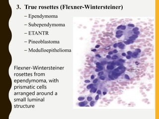 3. True rosettes (Flexner-Wintersteiner)
– Ependymoma
– Subependymoma
– ETANTR
– Pineoblastoma
– Medulloepithelioma
Flexner-Wintersteiner
rosettes from
ependymoma, with
prismatic cells
arranged around a
small luminal
structure
 