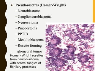 4. Pseudorosettes (Homer-Wright)
–Neuroblastoma
–Ganglioneuroblastoma
–Neurocytoma
–Pineocytoma
–PPTID
–Medulloblastoma
–Rosette forming
glioneural tumor
Homer- Wright rosettes
from neuroblastoma,
with central tangles of
fibrillary processes
 