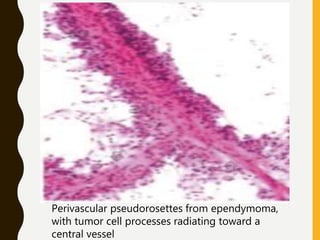Perivascular pseudorosettes from ependymoma,
with tumor cell processes radiating toward a
central vessel
 