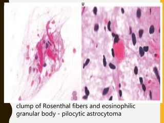 clump of Rosenthal fibers and eosinophilic
granular body - pilocytic astrocytoma
 