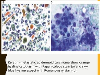 Keratin -metastatic epidermoid carcinoma show orange
hyaline cytoplasm with Papanicolaou stain (a) and sky-
blue hyaline aspect with Romanowsky stain (b)
 
