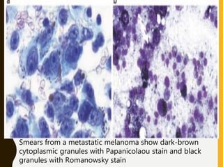 Smears from a metastatic melanoma show dark-brown
cytoplasmic granules with Papanicolaou stain and black
granules with Romanowsky stain
 