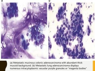 (a) Metastatic mucinous colonic adenocarcinoma with abundant thick
mucoid background. (b) Metastatic lung adenocarcinoma displays
numerous intracytoplasmic vacuolar purple granules or “magenta bodies”
 