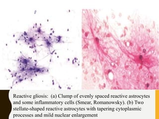 Reactive gliosis: (a) Clump of evenly spaced reactive astrocytes
and some inflammatory cells (Smear, Romanowsky). (b) Two
stellate-shaped reactive astrocytes with tapering cytoplasmic
processes and mild nuclear enlargement
 