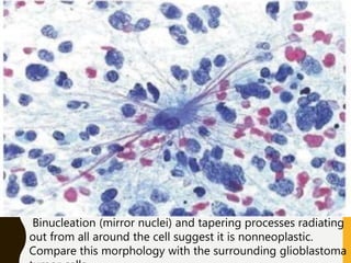 Binucleation (mirror nuclei) and tapering processes radiating
out from all around the cell suggest it is nonneoplastic.
Compare this morphology with the surrounding glioblastoma
 