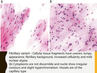 Fibrillary variant - Cellular tissue fragments have uneven, lumpy
appearance, fibrillary background, increased cellularity and mild
nuclear atypia.
(b) Cytoplasms are not discernible and nuclei show irregular
contours and slight hyperchromatism. Vessels are of the
capillary type
 