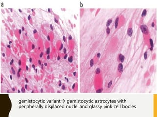 gemistocytic variant gemistocytic astrocytes with
peripherally displaced nuclei and glassy pink cell bodies
 