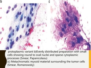 protoplasmic variant b)Evenly distributed preparation with small
cells showing round to oval nuclei and sparse cytoplasmic
processes (Smear, Papanicolaou)
(c) Metachromatic myxoid material surrounding the tumor cells
(Smear, Romanowsky)
 