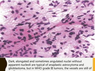 Dark, elongated and sometimes angulated nuclei without
apparent nucleoli are typical of anaplastic astrocytoma and
glioblastoma, but in WHO grade III tumors, the vessels are still of
 