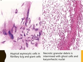 Atypical asytrocytic cells in
fibrillary b/g and giant cells
Necrotic granular debris is
intermixed with ghost cells and
karyorrhectic nuclei
 