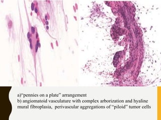 a)“pennies on a plate” arrangement
b) angiomatoid vasculature with complex arborization and hyaline
mural fibroplasia, perivascular aggregations of “piloid” tumor cells
 