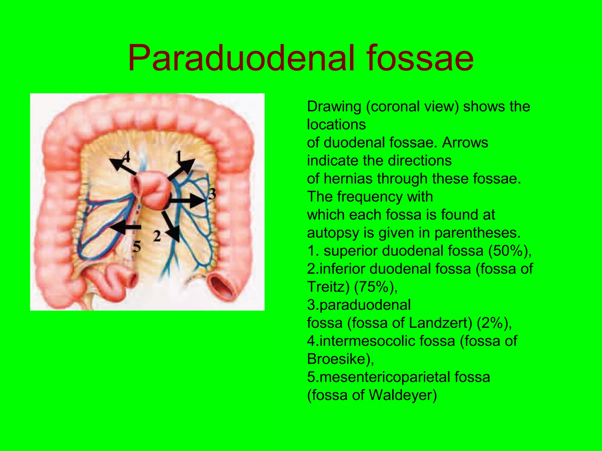 Paraduodenal fossae 
Drawing (coronal view) shows the 
locations 
of duodenal fossae. Arrows 
indicate the directions 
of hernias through these fossae. 
The frequency with 
which each fossa is found at 
autopsy is given in parentheses. 
1. superior duodenal fossa (50%), 
2.inferior duodenal fossa (fossa of 
Treitz) (75%), 
3.paraduodenal 
fossa (fossa of Landzert) (2%), 
4.intermesocolic fossa (fossa of 
Broesike), 
5.mesentericoparietal fossa 
(fossa of Waldeyer) 
 