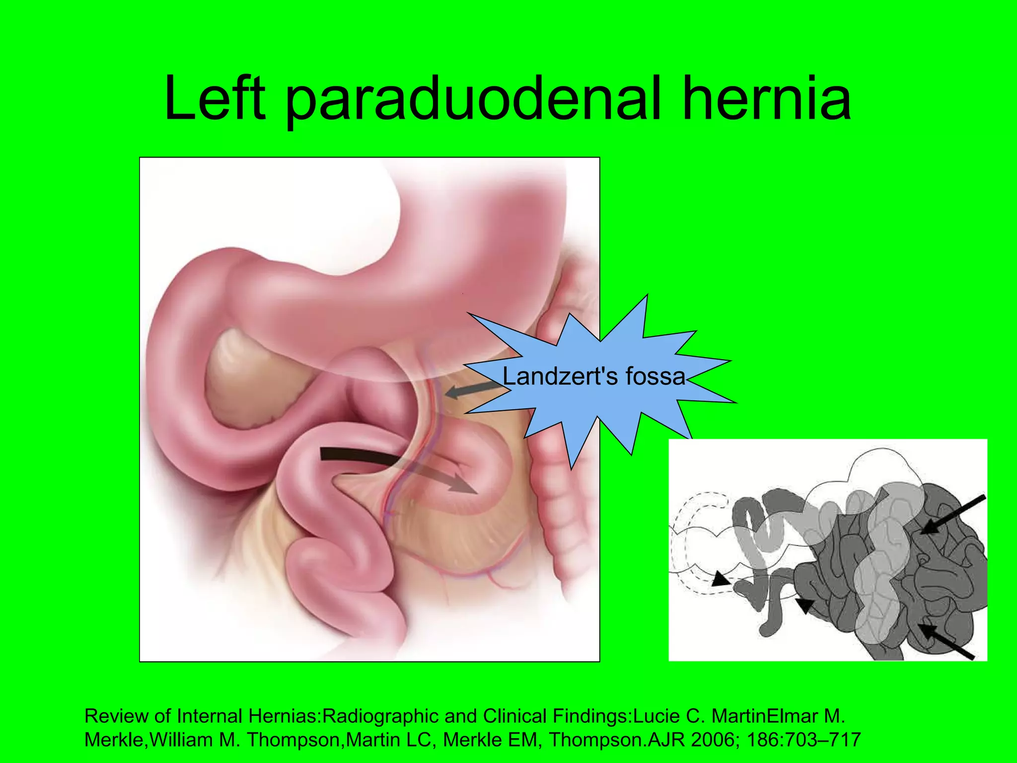 Left paraduodenal hernia 
Landzert's fossa 
Review of Internal Hernias:Radiographic and Clinical Findings:Lucie C. MartinElmar M. 
Merkle,William M. Thompson,Martin LC, Merkle EM, Thompson.AJR 2006; 186:703–717 
 