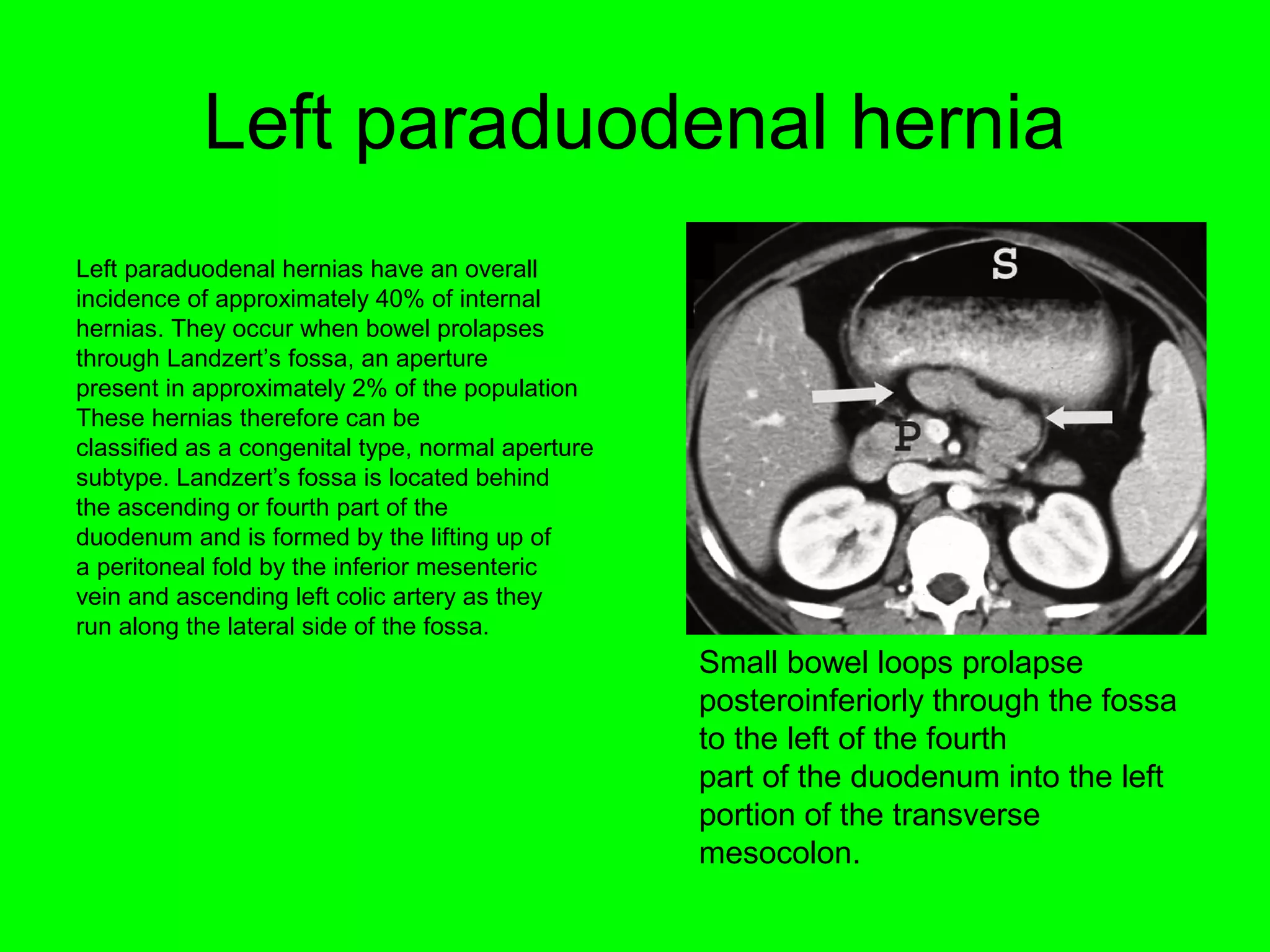 Left paraduodenal hernia 
Left paraduodenal hernias have an overall 
incidence of approximately 40% of internal 
hernias. They occur when bowel prolapses 
through Landzert’s fossa, an aperture 
present in approximately 2% of the population 
These hernias therefore can be 
classified as a congenital type, normal aperture 
subtype. Landzert’s fossa is located behind 
the ascending or fourth part of the 
duodenum and is formed by the lifting up of 
a peritoneal fold by the inferior mesenteric 
vein and ascending left colic artery as they 
run along the lateral side of the fossa. 
Small bowel loops prolapse 
posteroinferiorly through the fossa 
to the left of the fourth 
part of the duodenum into the left 
portion of the transverse 
mesocolon. 
 