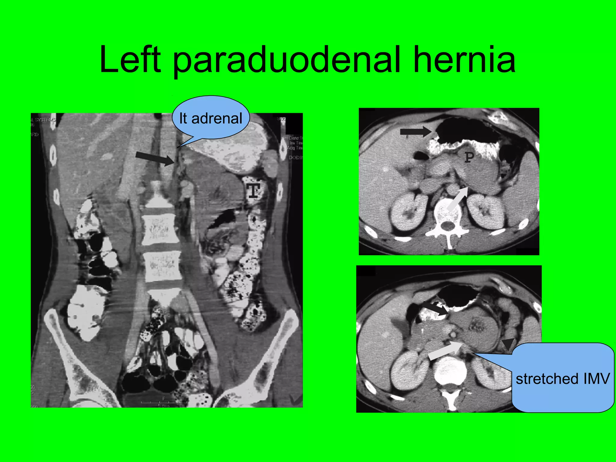 Left paraduodenal hernia 
lt adrenal 
stretched IMV 
 