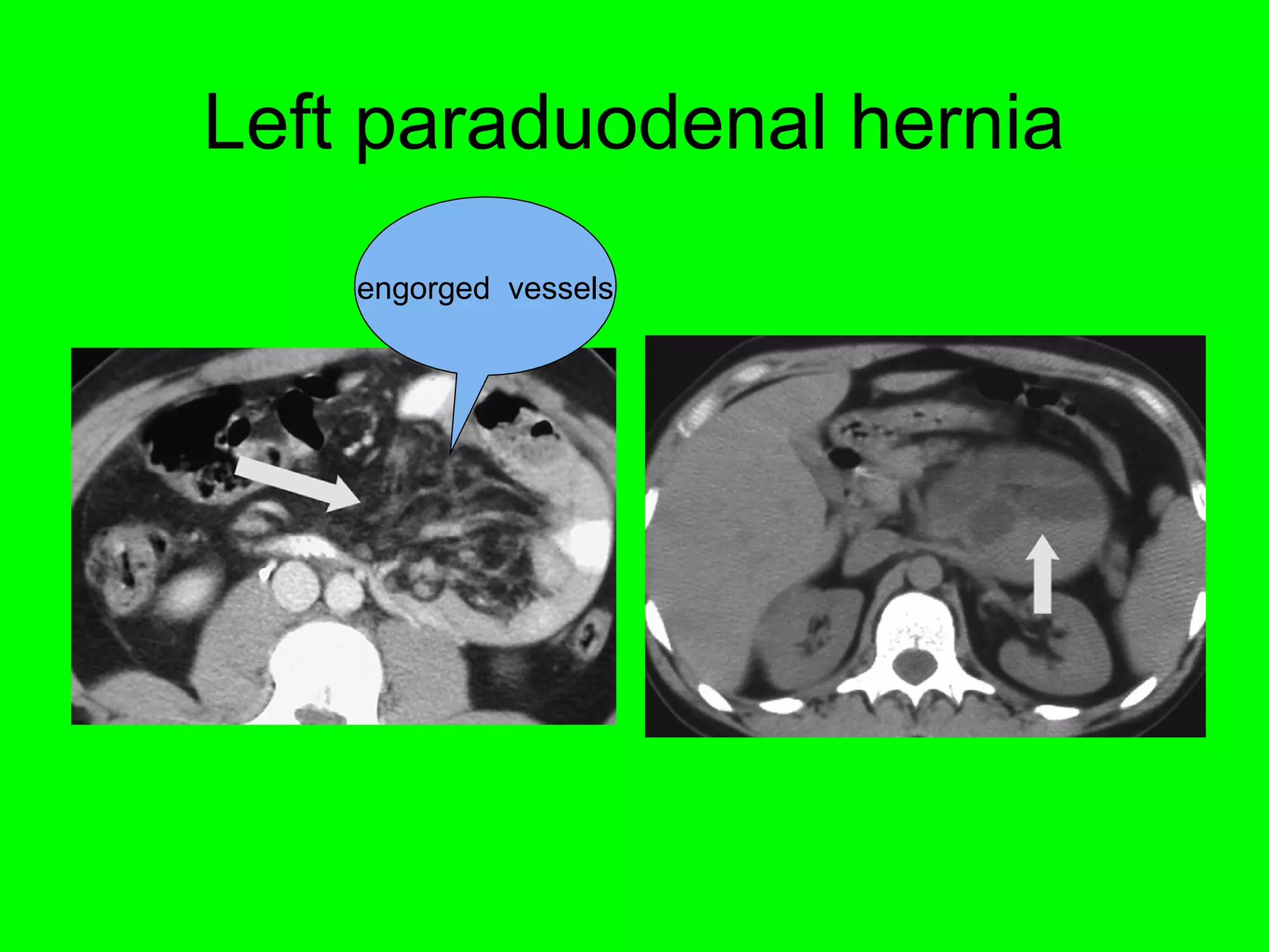 Left paraduodenal hernia 
engorged vessels 
 