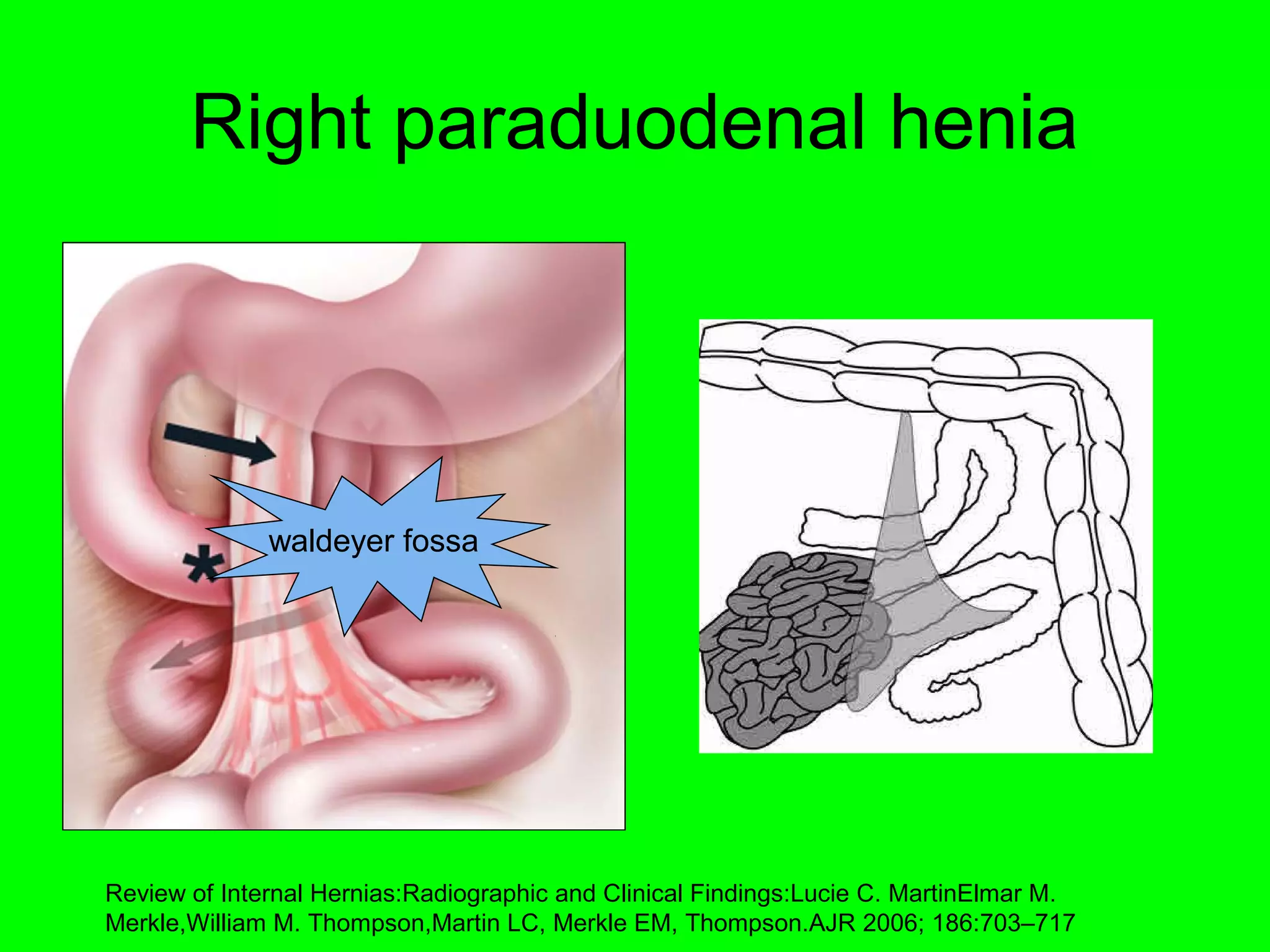 Right paraduodenal henia 
waldeyer fossa 
Review of Internal Hernias:Radiographic and Clinical Findings:Lucie C. MartinElmar M. 
Merkle,William M. Thompson,Martin LC, Merkle EM, Thompson.AJR 2006; 186:703–717 
 
