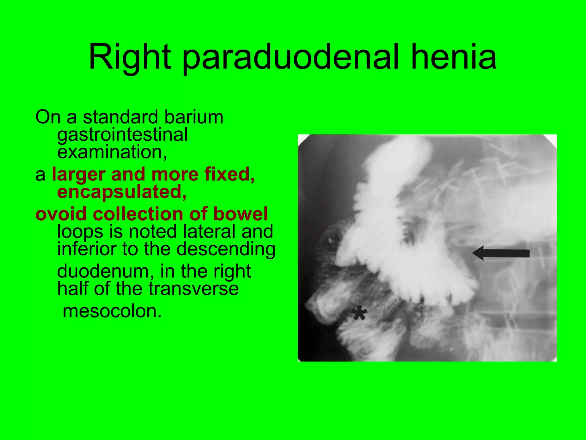 Right paraduodenal henia 
On a standard barium 
gastrointestinal 
examination, 
a larger and more fixed, 
encapsulated, 
ovoid collection of bowel 
loops is noted lateral and 
inferior to the descending 
duodenum, in the right 
half of the transverse 
mesocolon. 
 