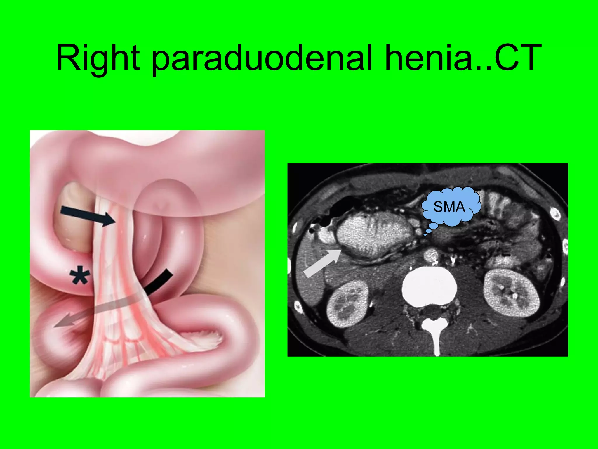 Right paraduodenal henia..CT 
SMA 
 