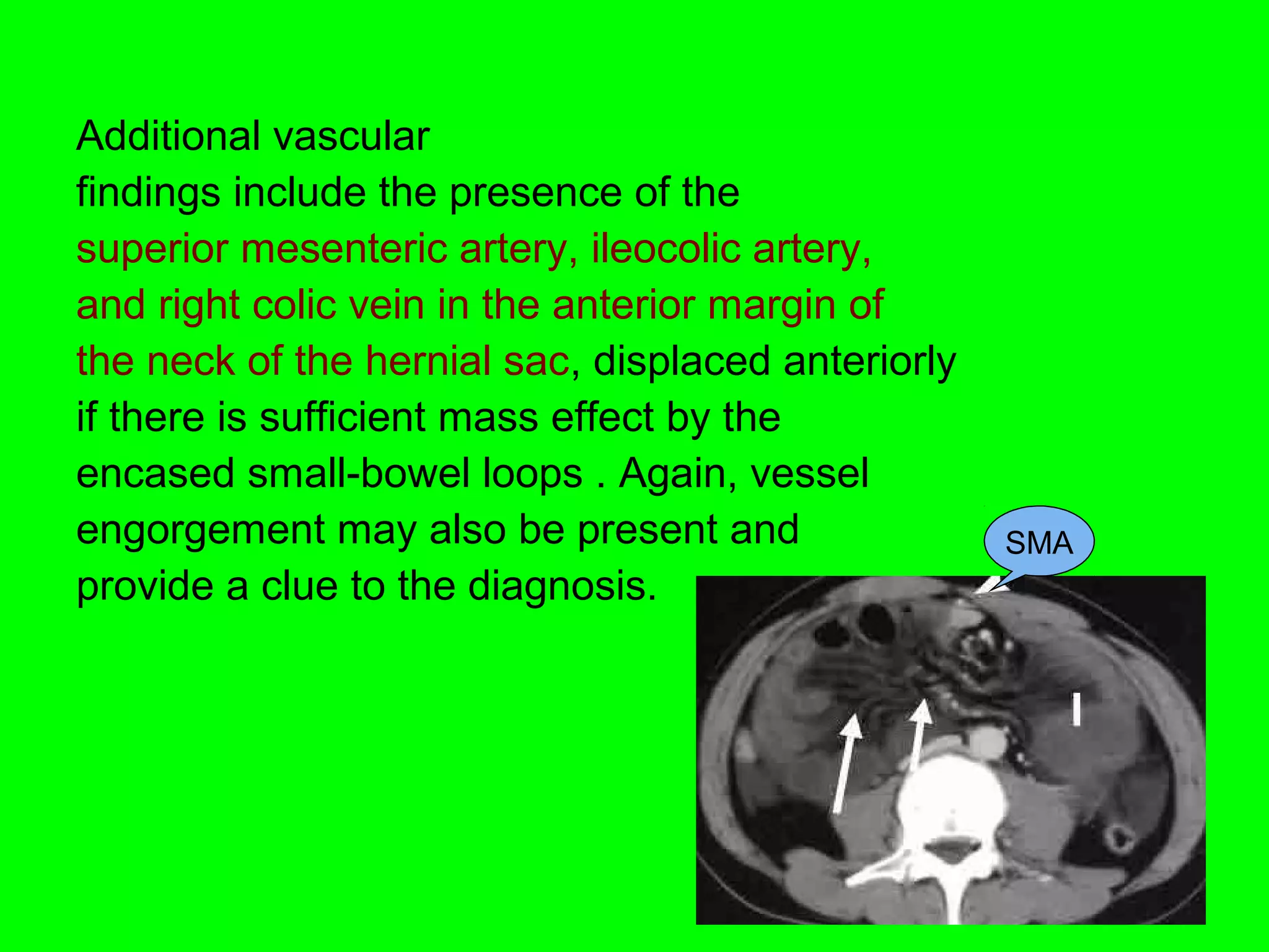 Additional vascular 
findings include the presence of the 
superior mesenteric artery, ileocolic artery, 
and right colic vein in the anterior margin of 
the neck of the hernial sac, displaced anteriorly 
if there is sufficient mass effect by the 
encased small-bowel loops . Again, vessel 
engorgement may also be present and 
provide a clue to the diagnosis. 
SMA 
 