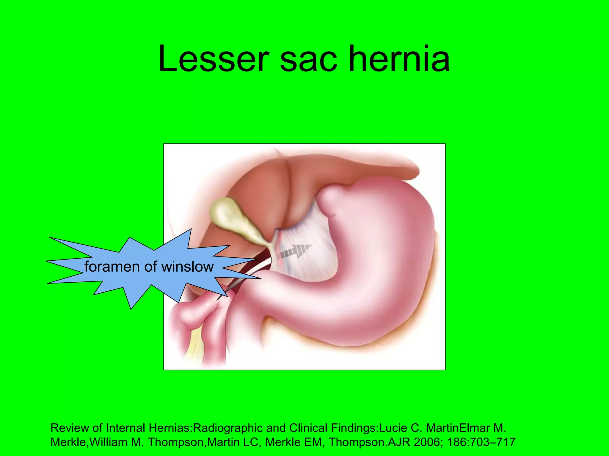 Lesser sac hernia 
foramen of winslow 
Review of Internal Hernias:Radiographic and Clinical Findings:Lucie C. MartinElmar M. 
Merkle,William M. Thompson,Martin LC, Merkle EM, Thompson.AJR 2006; 186:703–717 
 