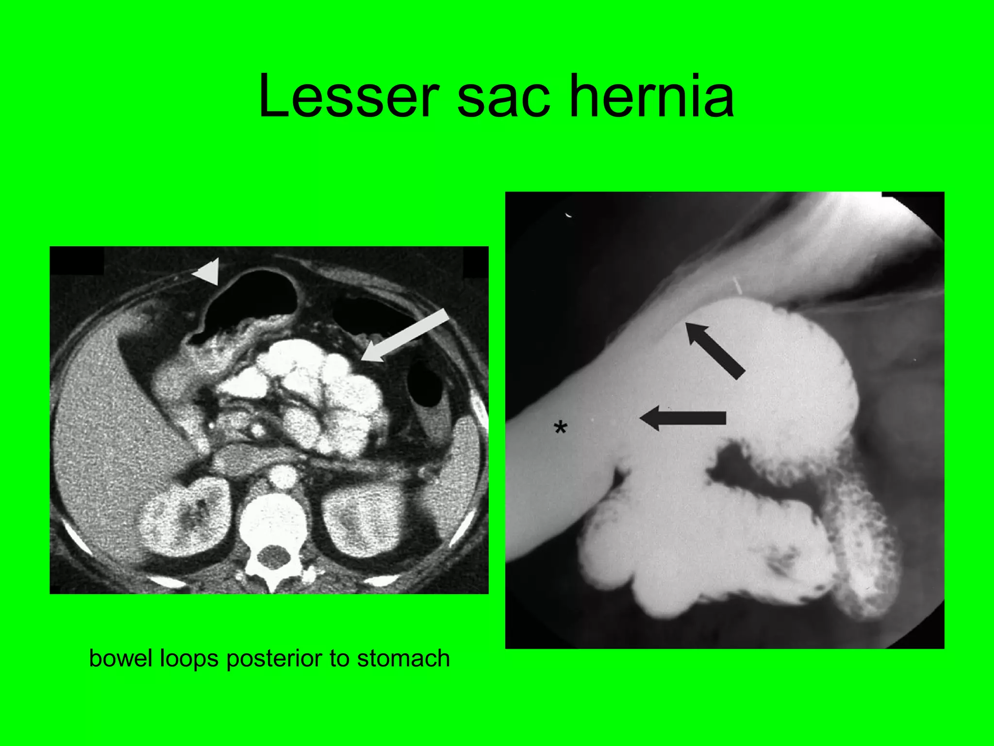 Lesser sac hernia 
bowel loops posterior to stomach 
 