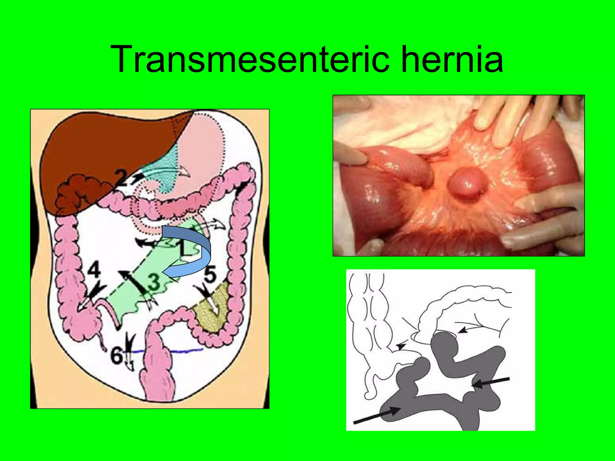 Transmesenteric hernia 
 