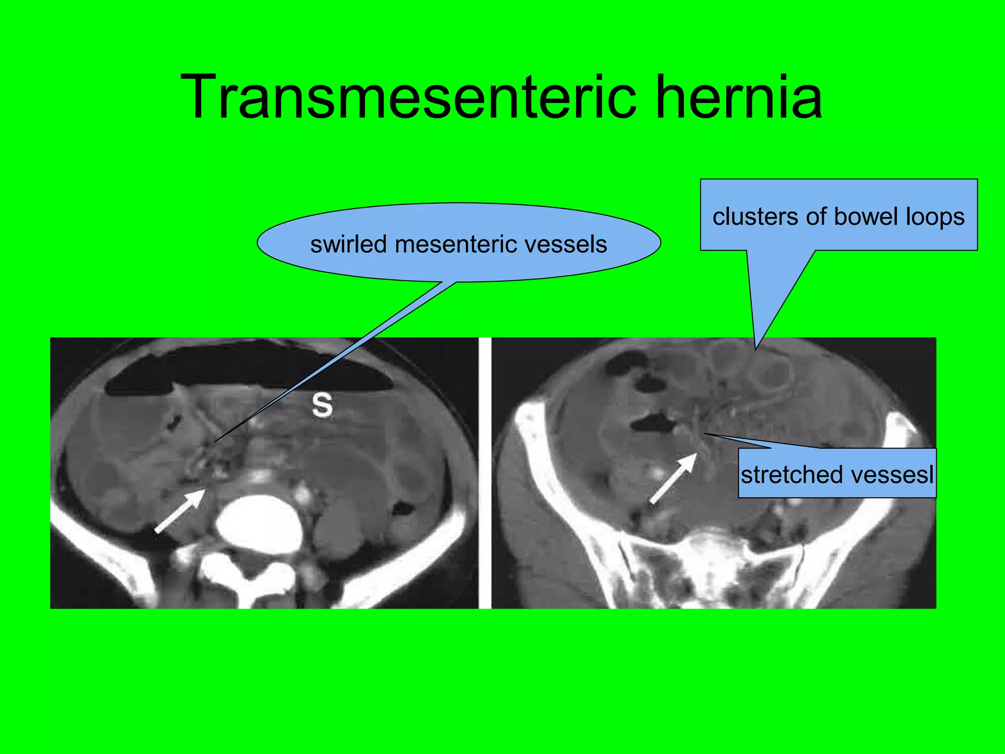 Transmesenteric hernia 
swirled mesenteric vessels 
clusters of bowel loops 
stretched vessesl 
 